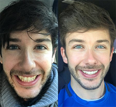 Invisalign - Before and After