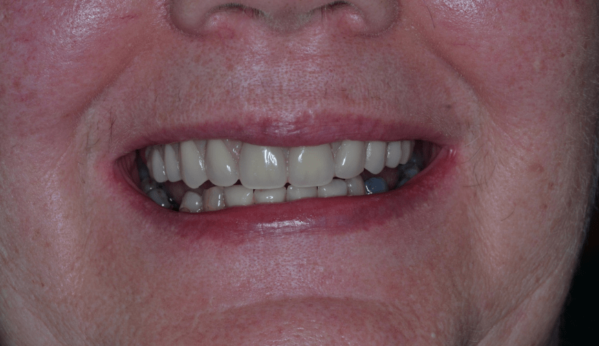 After - Durham Dental