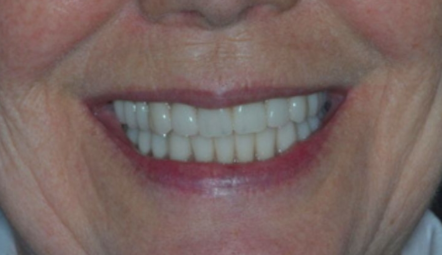 After - Durham Dental
